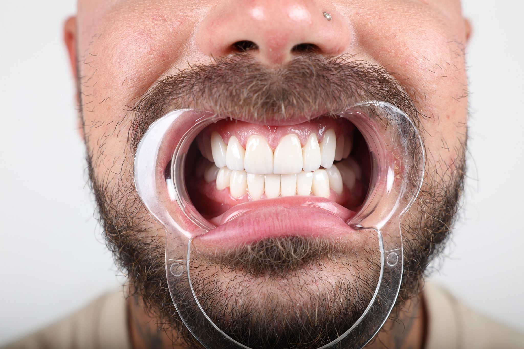 After Zirconia Crown Treatment